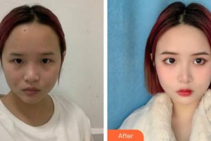 衡水天宏醫(yī)療美容醫(yī)院王鳳蘭整形價(jià)格表附無針?biāo)饫故?>
</a>
<h3 class=