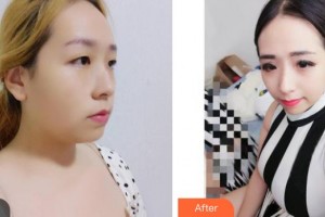 衡水天宏醫(yī)療美容醫(yī)院王蒙整形價(jià)格表附鼻部綜合案例展示