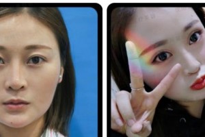 衡水唯美醫(yī)療美容門診部田振宇整形價(jià)格表附自體脂肪全臉填充案例展示