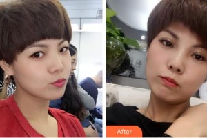 衡水愛爾眼科醫(yī)院王慈整形價(jià)格表附埋線雙眼皮案例展示