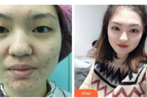 衡水愛爾眼科醫(yī)院韓賢奎整形價(jià)格表附眼部綜合案例展示