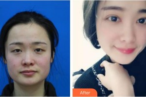 衡水愛爾眼科醫(yī)院胡連潤整形價(jià)格表附眼部綜合案例展示