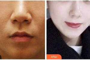 衡水尚美醫(yī)療美容門診部馮小軍整形價(jià)格表附埋線提升案例展示