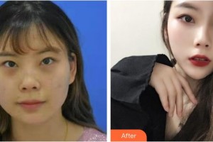 山西伊特雅整形美容門診部凌霄志整形價(jià)格表附E光嫩膚案例展示