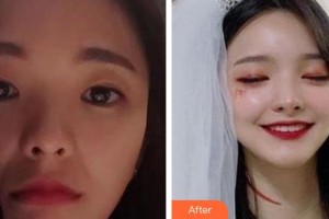 山西伊特雅整形美容門診部張輝整形價(jià)格表附去痘印痘坑例展示