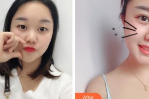 山西醫(yī)科大學(xué)第二醫(yī)院整形科梁炳整形價(jià)格表附去痘印痘坑案例展示