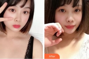 山西陽泉友愛醫(yī)院醫(yī)學(xué)美容科郭慶福整形價(jià)格表附自體脂肪隆胸案例展示