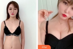 山西伊特雅整形美容門診部王鳳芹整形價(jià)格表附自體脂肪隆胸案例展示