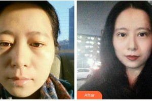 山西醫(yī)科大學(xué)第二醫(yī)院整形科郝敏整形價(jià)格表附祛斑祛痣案例展示