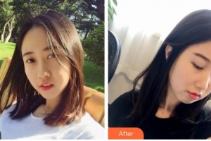 山西醫(yī)科大學(xué)附屬太鋼總醫(yī)院燒傷整形中心趙志偉整形價(jià)格表附彩光嫩膚案例展示