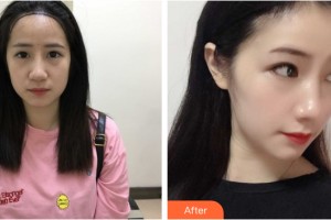 哈爾濱麗珍醫(yī)療美容醫(yī)院辛栄根整形價格表附植發(fā)案例展示