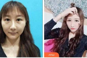 山西立仁激光整形醫(yī)院史炳炎整形價(jià)格表附光子嫩膚案例展示