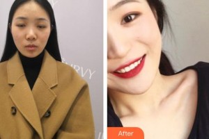 山西省整形外科醫(yī)院孟慶璋整形價(jià)格表附清潔祛痘案例展示