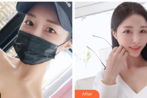 山西現(xiàn)代婦產(chǎn)醫(yī)院整形美容中心趙建華整形價(jià)格表附去痘印痘坑案例展示