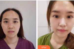 山西大醫(yī)院醫(yī)療美容整形中心張慧華整形價(jià)格表附激光祛斑案例展示