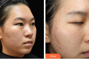 山西大醫(yī)院醫(yī)療美容整形中心郭晉宣整形價(jià)格表附激光祛斑案例展示