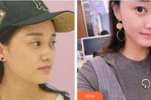 山西省眼科醫(yī)院張麗軍整形價(jià)格表附定點(diǎn)雙眼皮案例展示