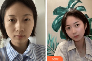 蘭州三愛整形美容醫(yī)院周媛整形價(jià)格表附皮膚美容案例展示