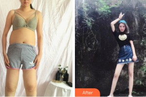 蘭州姜醫(yī)生醫(yī)療美容外科診所姜春仁整形價格表附大腿吸脂案例展示