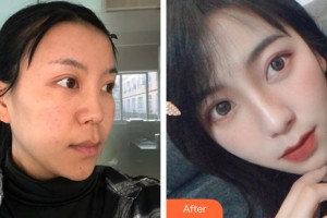 蘭州皙妍麗整形美容門診部王先東整形價格表附鼻部手術案例展示