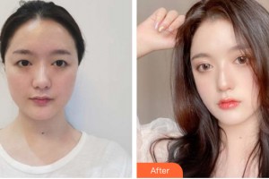 蘭州時光整形美容醫(yī)院羅梅整形價格表附眼部手術案例展示