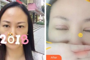 山西省眼科醫(yī)院馮雪亮整形價格表附切開雙眼皮案例展示