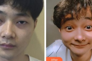 山西省眼科醫(yī)院李俊紅整形價格表附切開雙眼皮案例展示