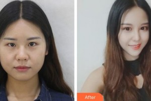 山西省眼科醫(yī)院常敏整形價格表附切開雙眼皮案例展示