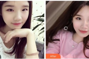 山西省眼科醫(yī)院高小琴整形價格表附眼部綜合案例展示