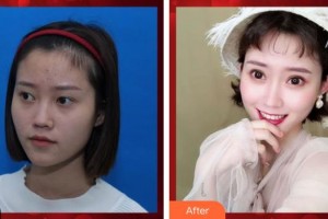 山西省眼科醫(yī)院湯兆強(qiáng)整形價格表附切開雙眼皮案例展示