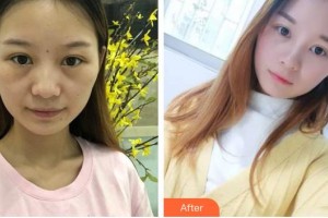 山西省眼科醫(yī)院趙軍梅整形價格表附激光去眼袋案例展示