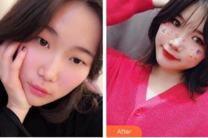 山西省眼科醫(yī)院申長禮整形價格表附切開雙眼皮案例展示