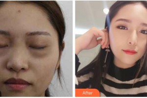 山西省眼科醫(yī)院吳艷整形價格表附激光去眼袋案例展示