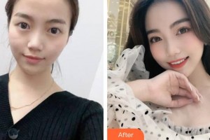 山西省眼科醫(yī)院孔淼整形價格表附眼部綜合案例展示