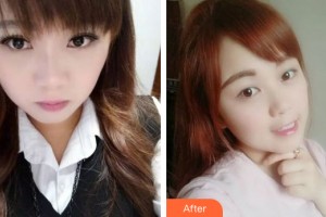 蘭州市口腔醫(yī)院陳彩云整形價格表附牙齒矯正案例展示