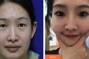 山西省眼科醫(yī)院柴飛燕整形價(jià)格表附眼部綜合案例展示