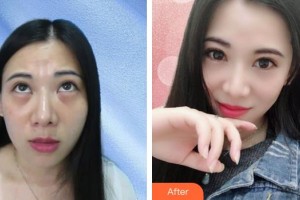 山西省眼科醫(yī)院劉文潔整形價(jià)格表附激光去眼袋案例展示