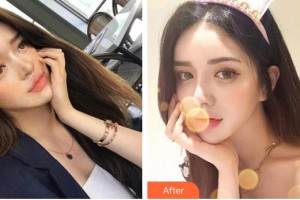 太原華美整形美容醫(yī)院暢巨花整形價格表附祛斑祛痣案例展示