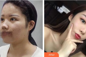 太原銀澤醫(yī)療美容門診部白愛國整形價格表附鼻部綜合案例展示