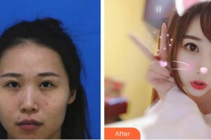 太原美之妍醫(yī)療美容診所曹立銘整形價格表附鼻部綜合案例展示