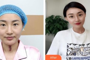 太原歐美蓮整形美容醫(yī)院姜泰燮整形價格表附去痘印痘坑例展示