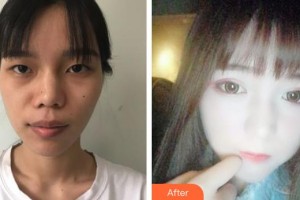 太原歐美蓮整形美容醫(yī)院馬世理整形價格表附鼻部綜合案例展示