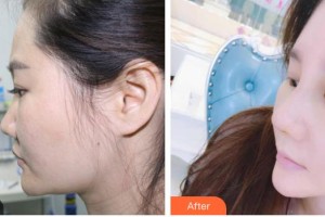 太原歐美蓮整形美容醫(yī)院張繁萍整形價格表附鼻部綜合案例展示