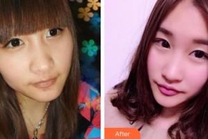 太原美雅楓（原裴世榮）整形美容醫(yī)院裴世榮整形價(jià)格表附膨體隆鼻案例展示