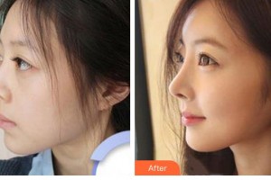 太原時(shí)光整形美容醫(yī)院路衛(wèi)國整形價(jià)格表附假體隆鼻案例展示