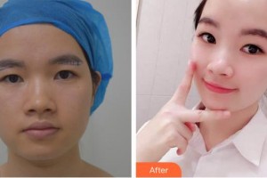 太原晉容整形美容門診部張步濤整形價(jià)格表附埋線提升案例展示