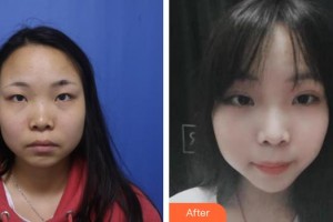 太原青松醫(yī)療美容門診部馮光整形價(jià)格表附埋線提升案例展示