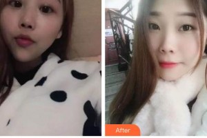 太原華美整形美容醫(yī)院鞏慧珍整形價(jià)格表附自鎖托槽矯正案例展示