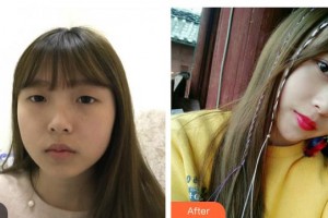 太原時(shí)光整形美容醫(yī)院張俊整形價(jià)格表附光子嫩膚案例展示