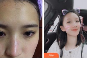 太原美之妍醫(yī)療美容診所冀慧霞整形價(jià)格表附激光祛斑案例展示